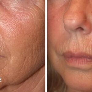 RF Face & Neck Treatment