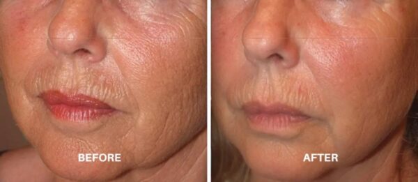 RF Face & Neck Treatment